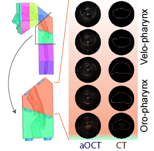 3D printed airway aOCT, CT